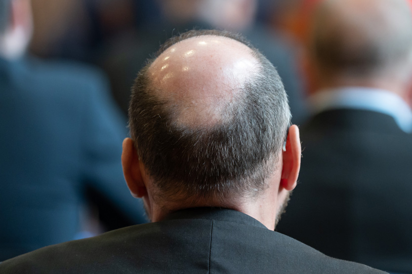 Лысеющий мужчина