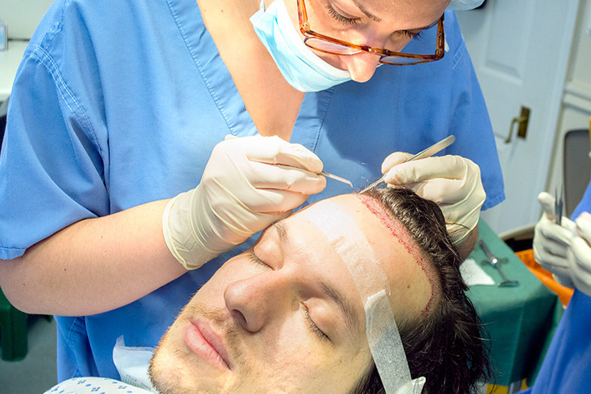 Операция по трансплантации волос